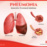 pneumonia