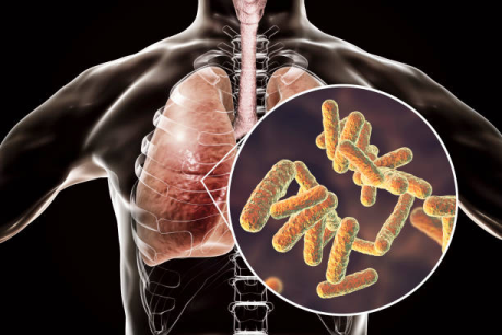 lungs affected by tuberculosis