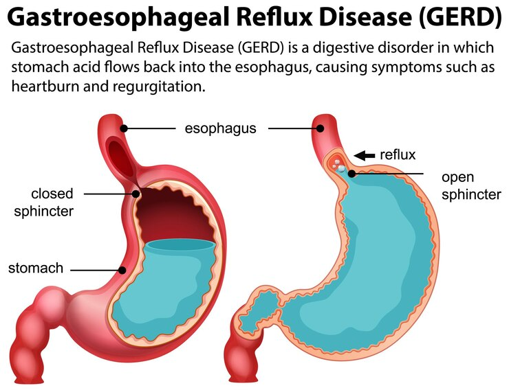 Gastroesophageal Reflux Disease (GERD