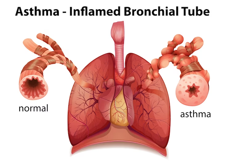 Asthma-inflamed bronchial tube