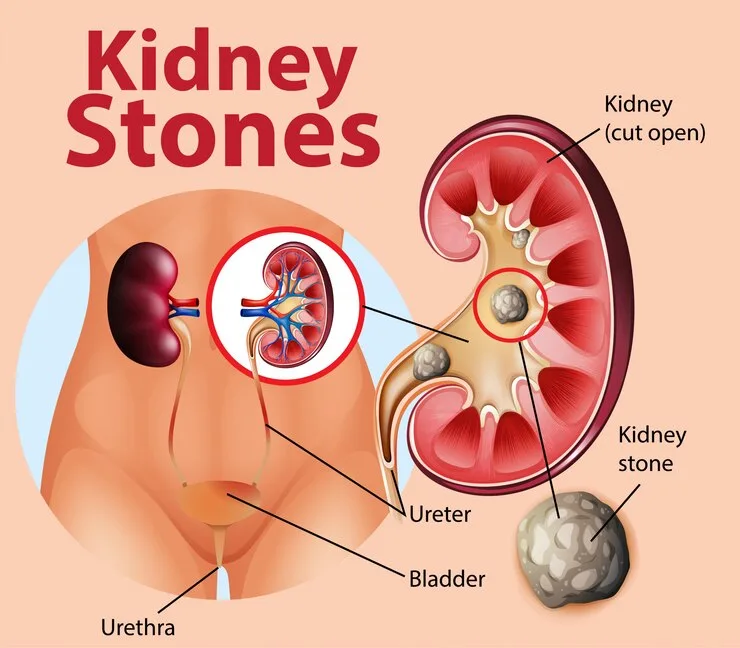 kidney stone image, ureter, bladder, urethera