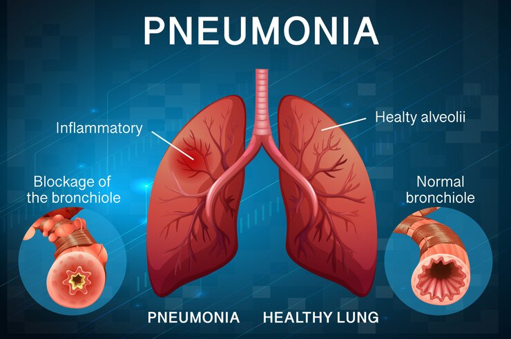 can urgent care diagnose pneumonia?