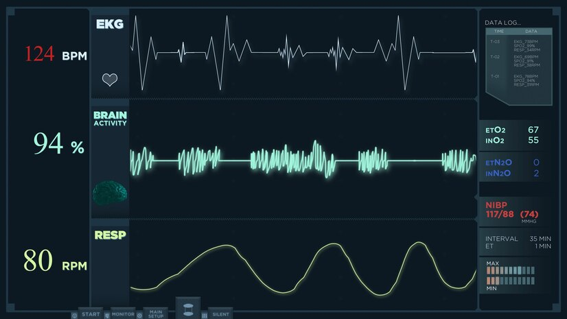 Possible complications of an ECG or EKG. diagnosing heart beat at 124BPM or 80RPM