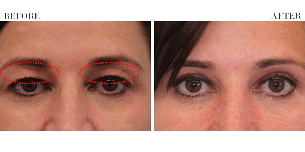 Plasma Pen Before and After