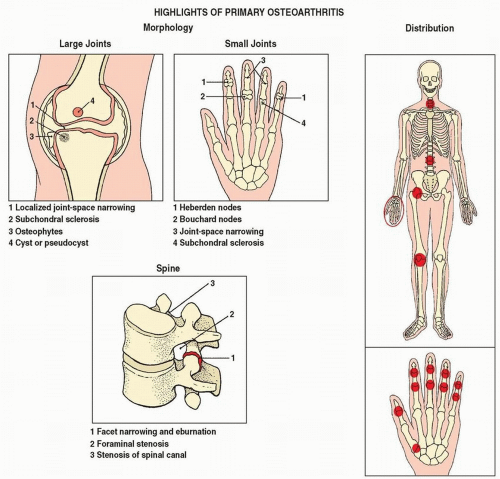 Degenerative joint disease icd 10