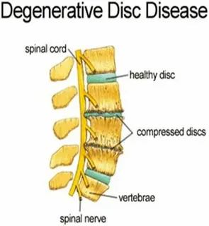 Degenerative joint disease icd 10 code