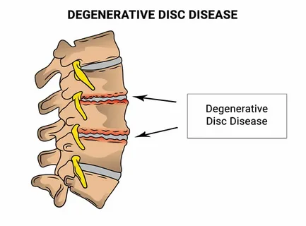 multilevel degenerative disc disease