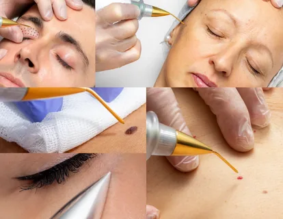 plasma pen treatment