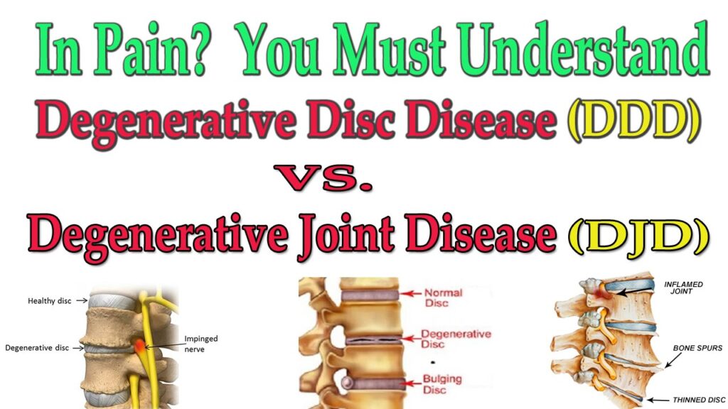 things to avoid with degenerative disc disease