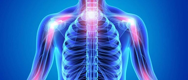 Osteoarthritis ICD 10